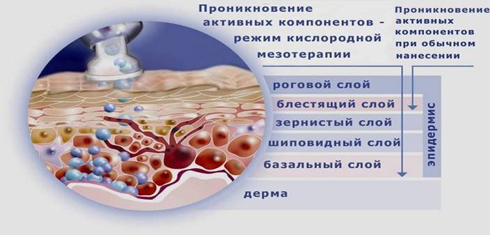 преимущества кислородной мезотерапии схема воздействия кислородной мезотерапии