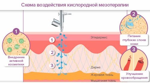 схема воздействия неинъекционной мезотерапии Dermadrop схема воздействия кислородной мезотерапии