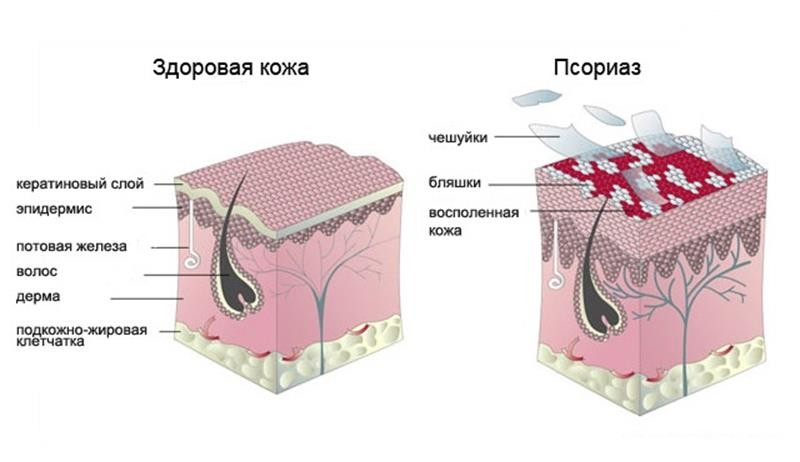 псориаз